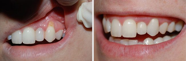 Gum Surgery Treatment