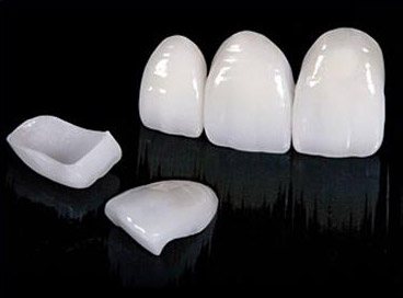 What are Porcelain Veneers