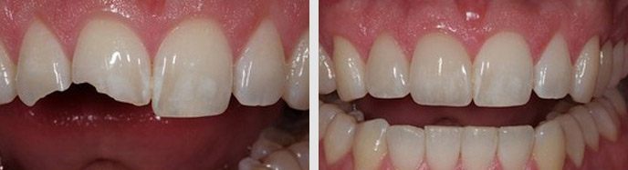 How are Porcelain Veneers prepared and placed