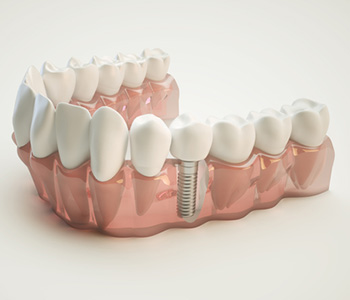 What is the process of obtaining dental implants in Brampton area