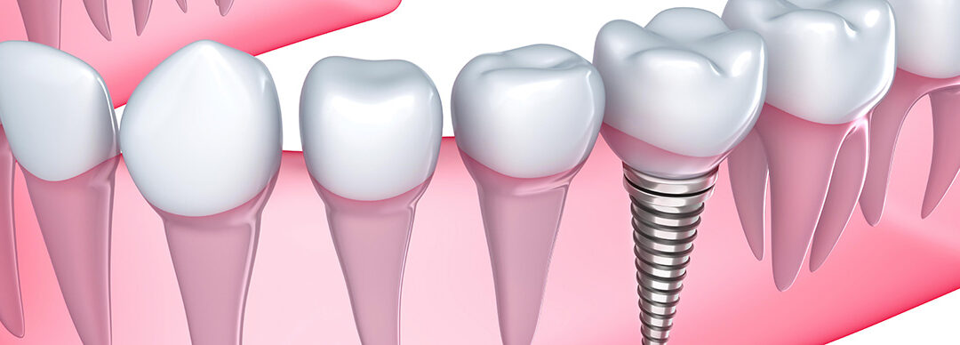 Complete your smile with dental implants in Brampton, ON