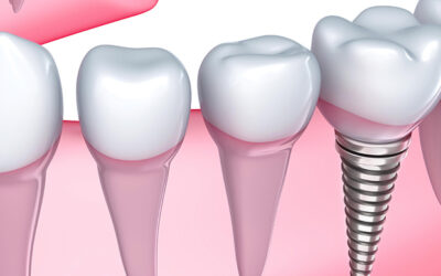 Complete your smile with dental implants in Brampton, ON