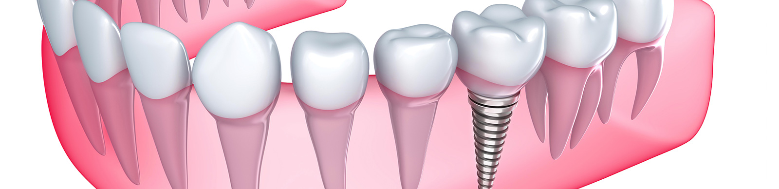 Full Mouth Teeth Implants in Brampton ON area