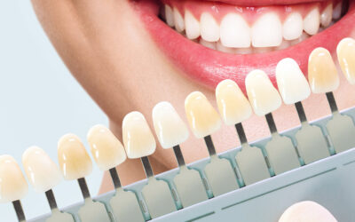 Reasons Why You Should Consider Veneers for a Perfect Smile