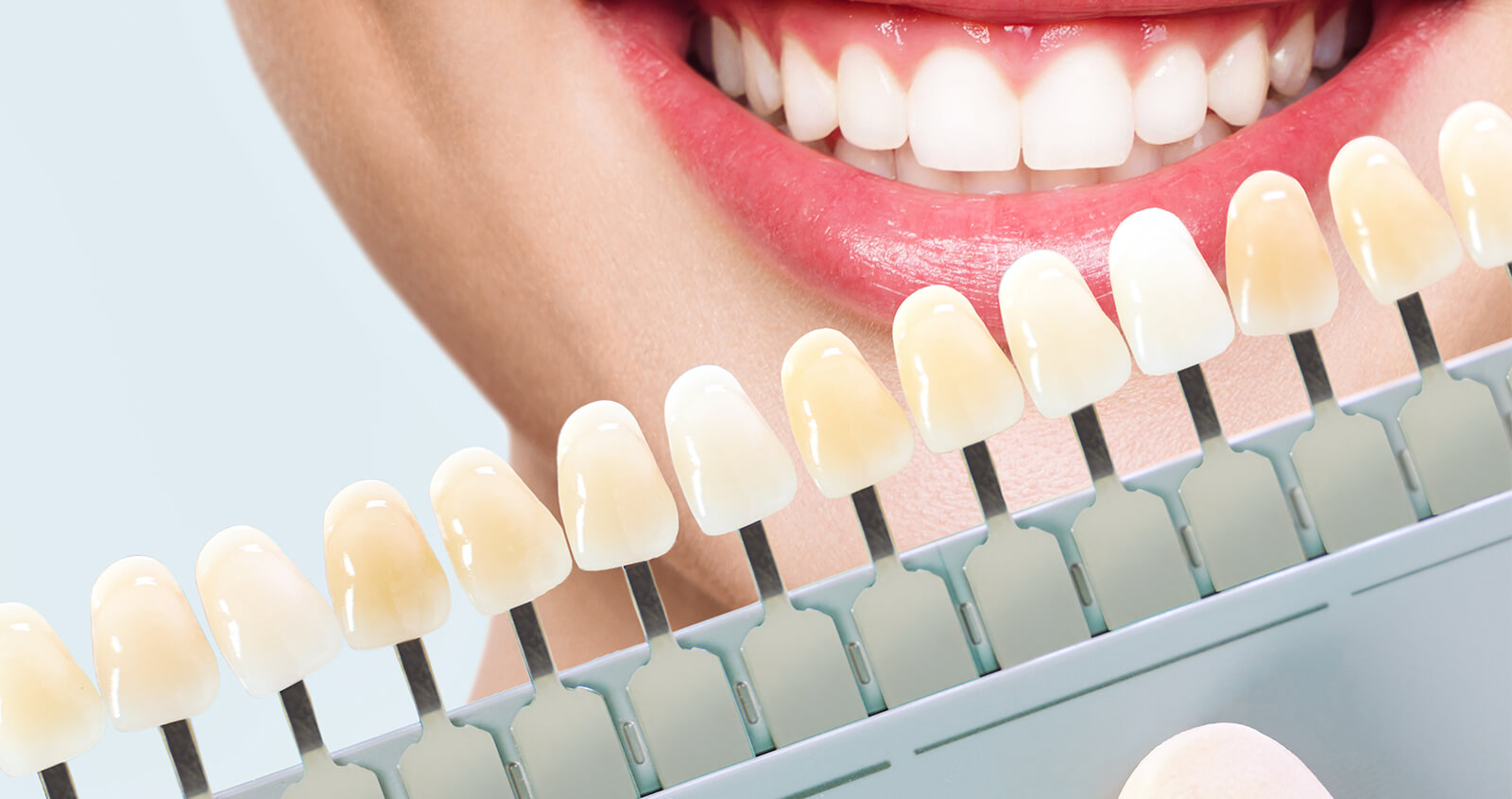 Cosmetic Veneers for Teeth in Brampton Area