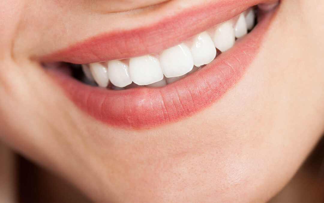 Cosmetic Dental Bonding in Brampton Ontario Area