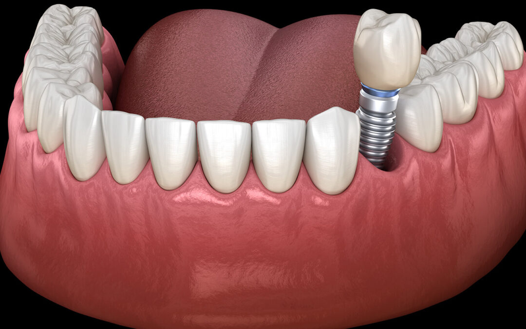 Tooth Implant Service in Brampton ON Area