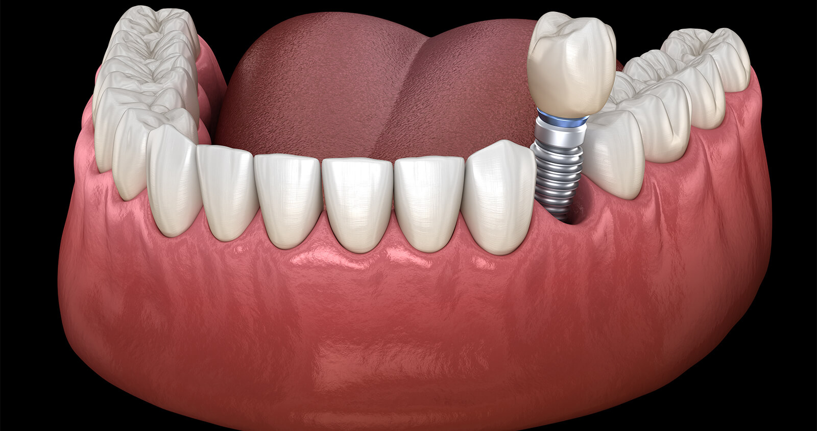 Tooth Implant Service in Brampton ON Area