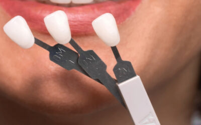 Trust the results from your veneers to us … we live up to our name with stunning yet natural-looking outcomes!