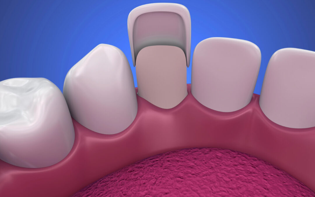 6 Transformative Benefits of Porcelain Veneers for a Youthful Smile