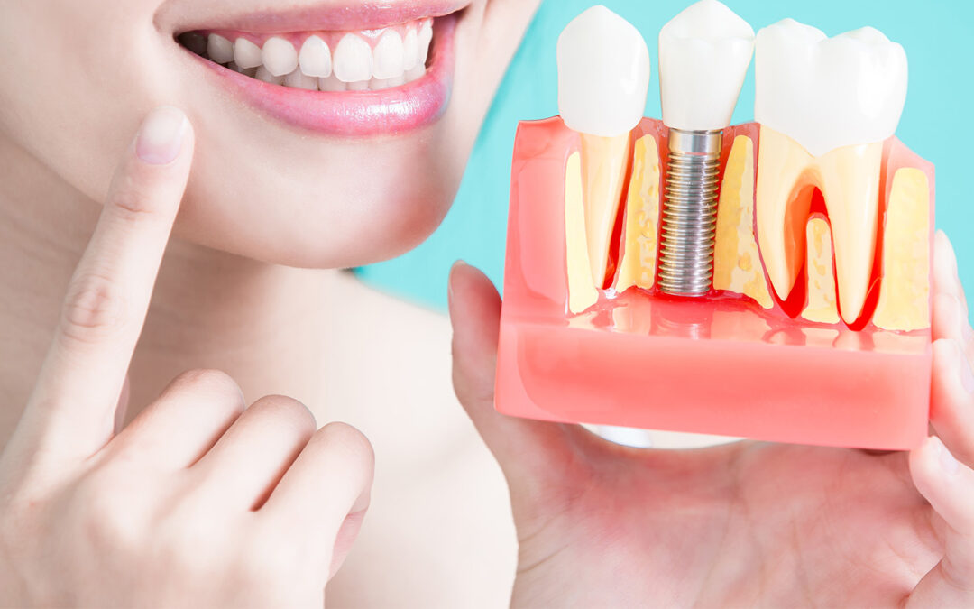 Understanding Dental Implants: What You Need to Know